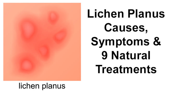 Lichen Planus Causes, Symptoms & 9 Natural Treatments