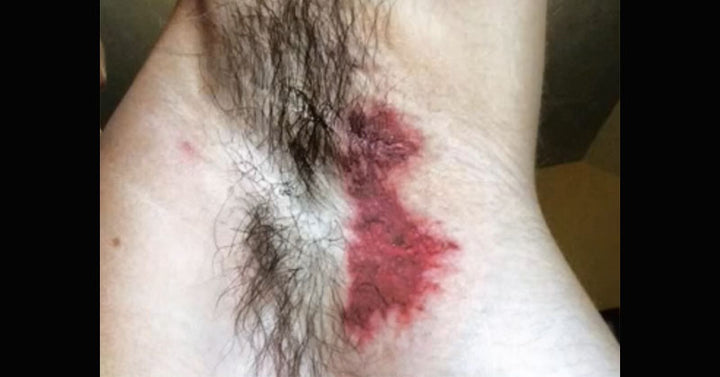 armpit rash FI