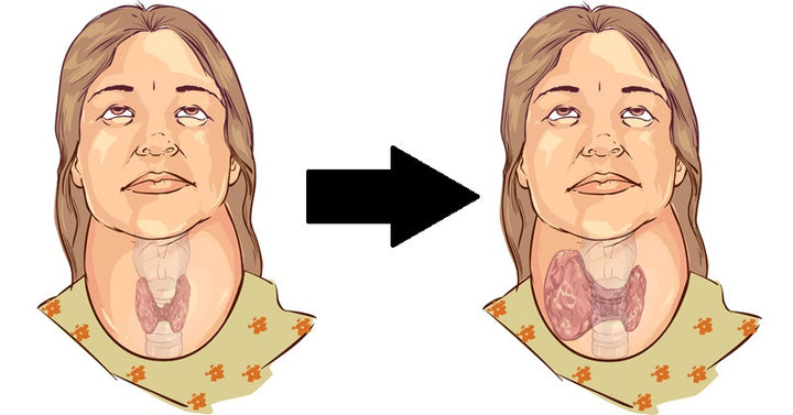 thyroid problems FI