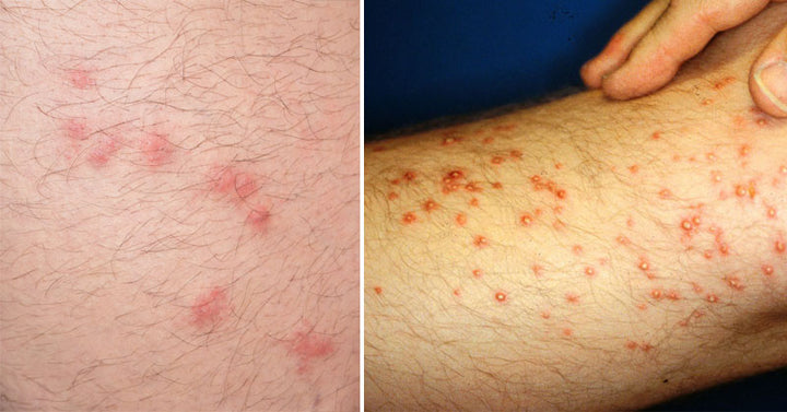 bug bites FI