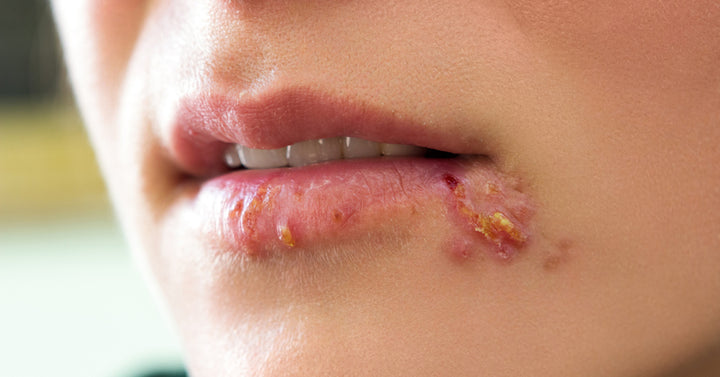 cold sores FI
