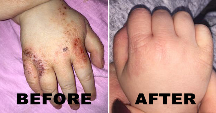 cream eczema FI