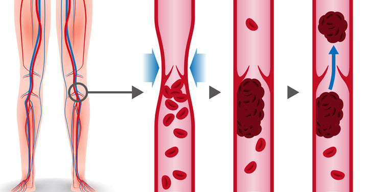 deep vein thrombosis FI