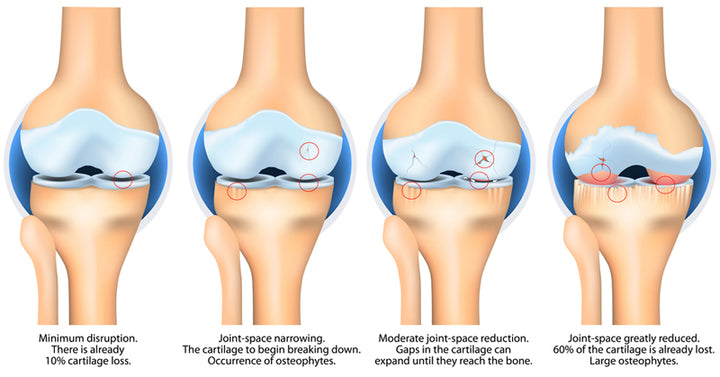 degenerative joint disease FI