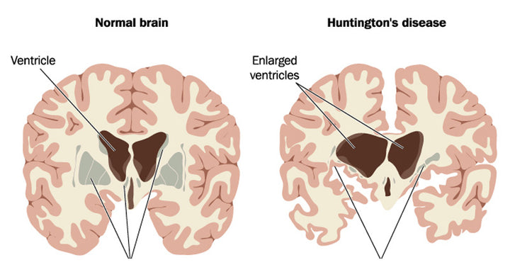 Huntington's Disease: Symptoms, Stages & 5 Natural Treatments