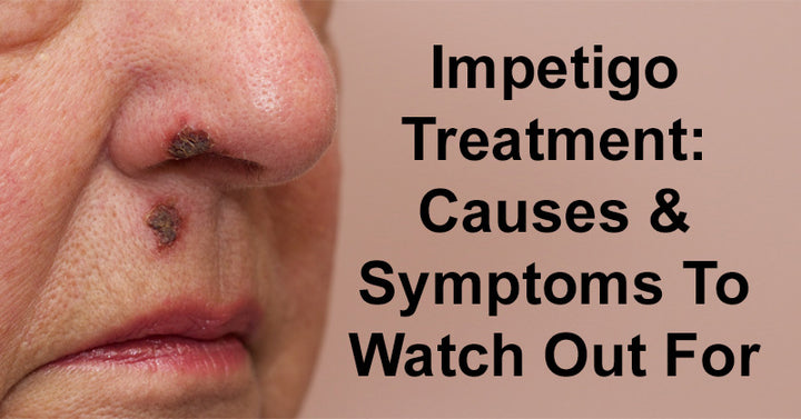 Impetigo Treatment: Causes & Symptoms To Watch Out For