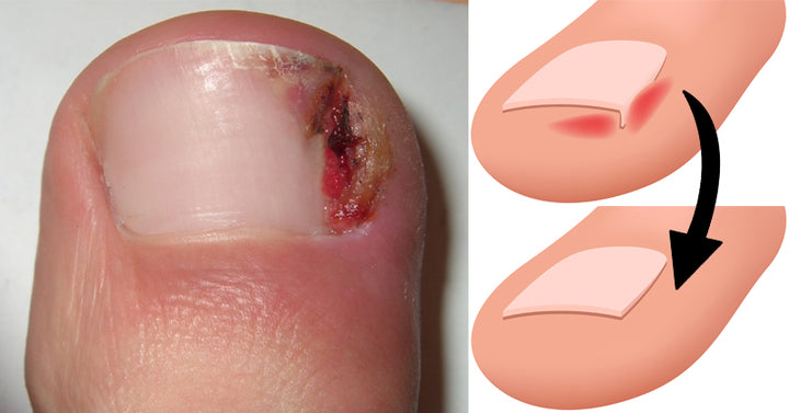 ingrown FI