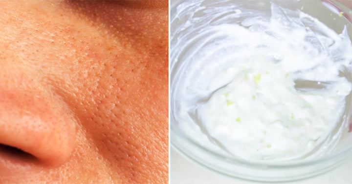large pores FI