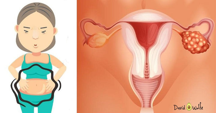 ovarian cancer