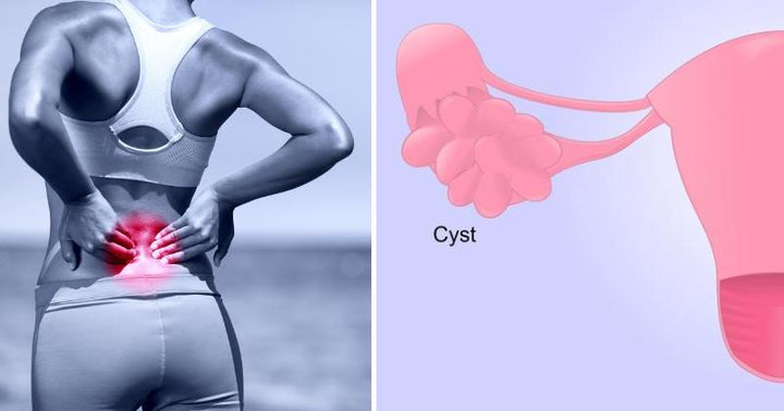 ovarian cyst