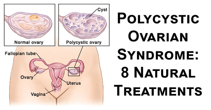 pcos treatments FI