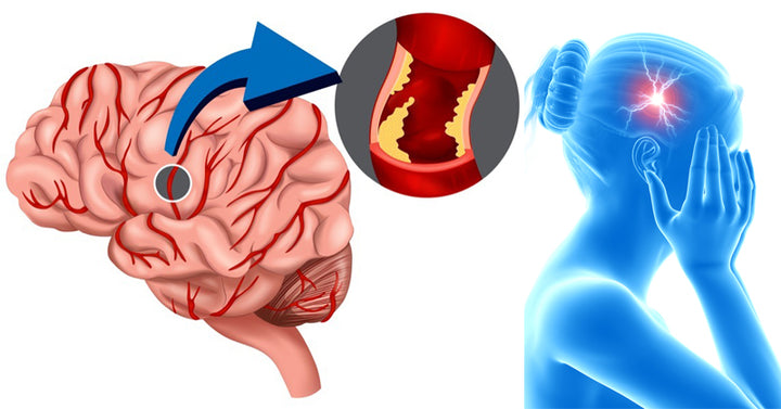 prevent stroke FI