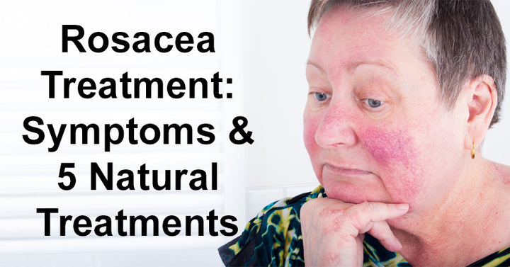 Rosacea Treatment: Symptoms & 5 Natural Treatments