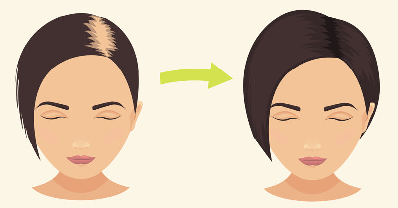 Alopecia Areata FI