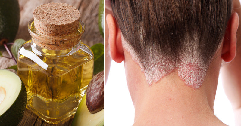 Avocado Oil: 5 Health Benefits