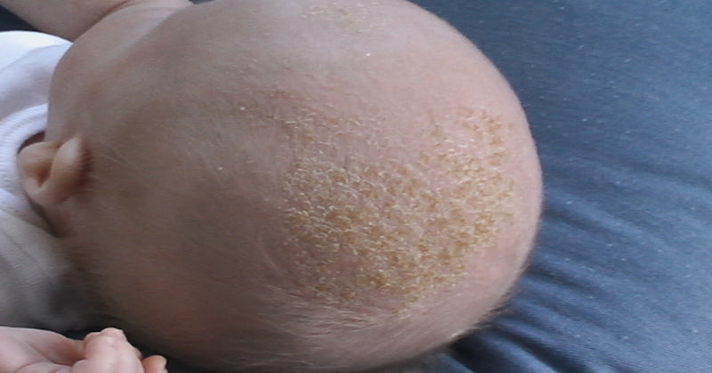 Baby_With_Cradle_Cap (1)