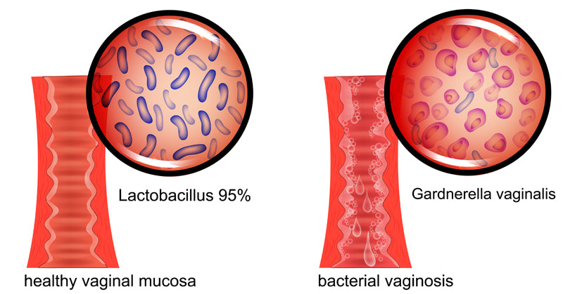 Bacterial Vaginosis FI