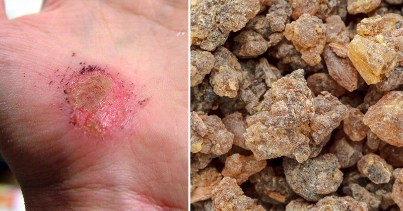 Benzoin Essential Oil: 10 Uses & Benefits