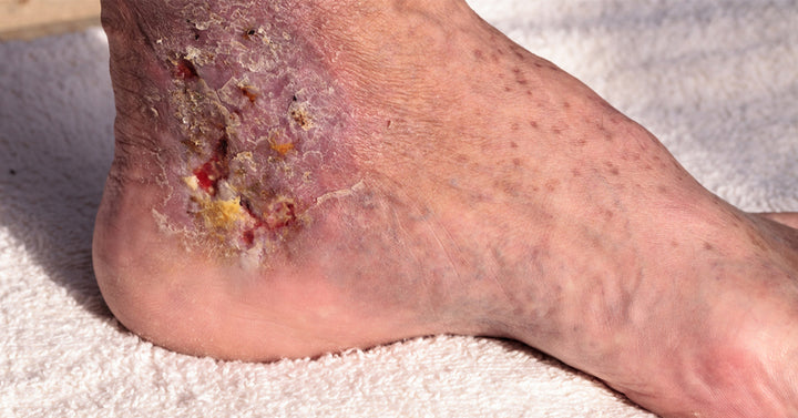 Cellulitis FI