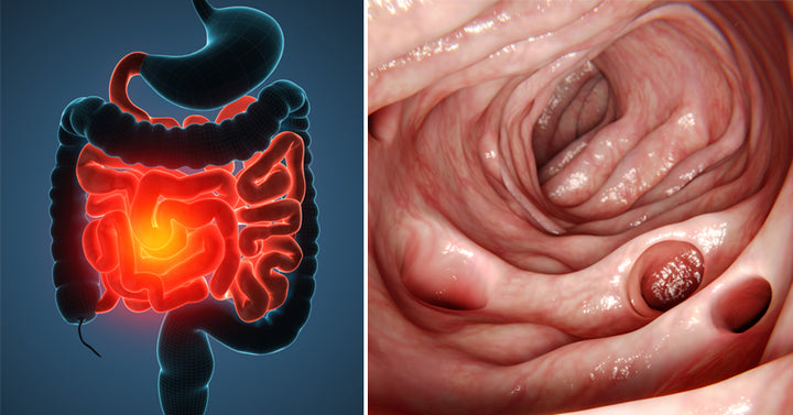 Diverticulitis Symptoms FI