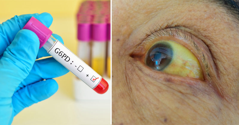 G6PD Deficiency: Symptoms & 4 Natural Treatments