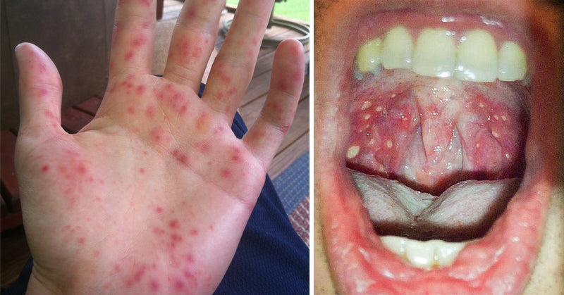 HFM disease FI