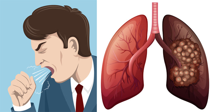 Lung Cancer FI
