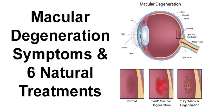 Macular Degeneration Symptoms & 6 Natural Treatments