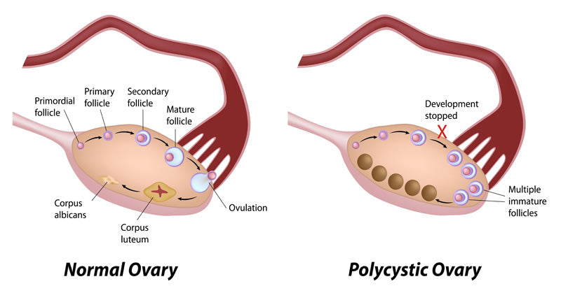 PCOS FI