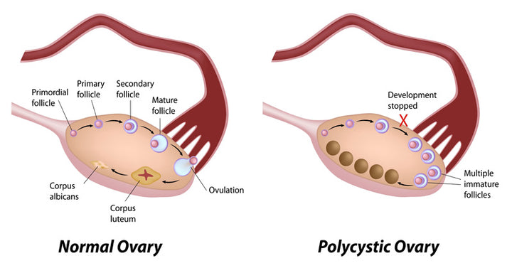 PCOS FI