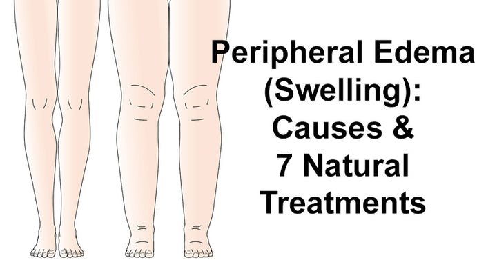 Peripheral Edema (Swelling): Causes & 7 Natural Treatments