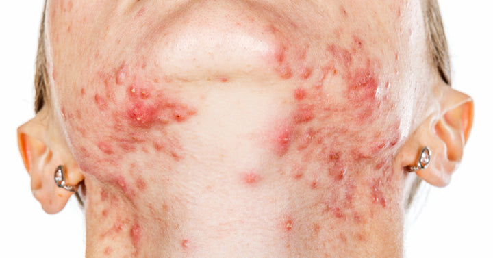 make acne disappear FI