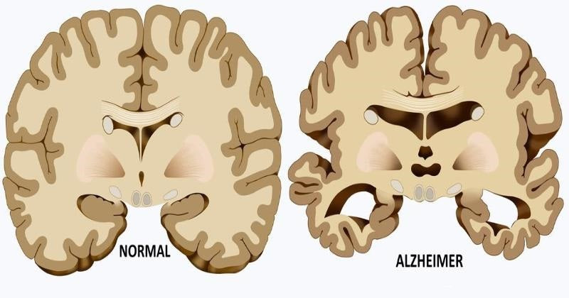 alzheimer causes FI