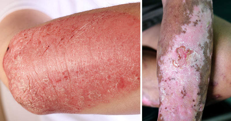 autoimmune diseases FI