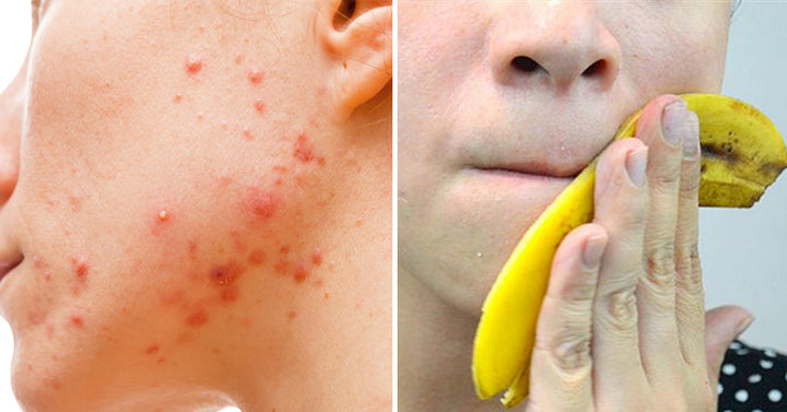 banana acne FI