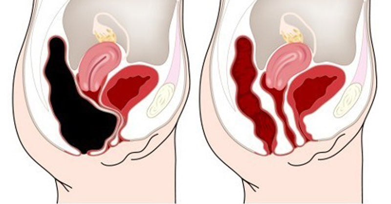 belly point constipation FI