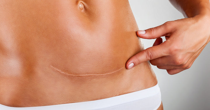 c-section scar FI