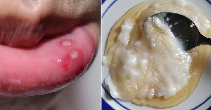 canker sore remedies FI