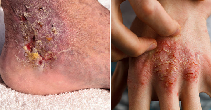cellulitis symptoms FI