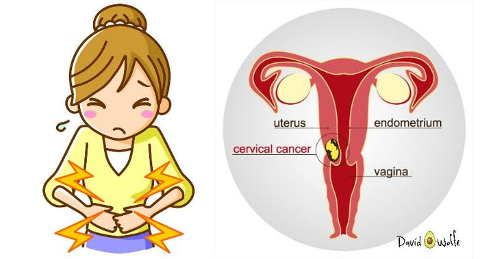 cervical cancer