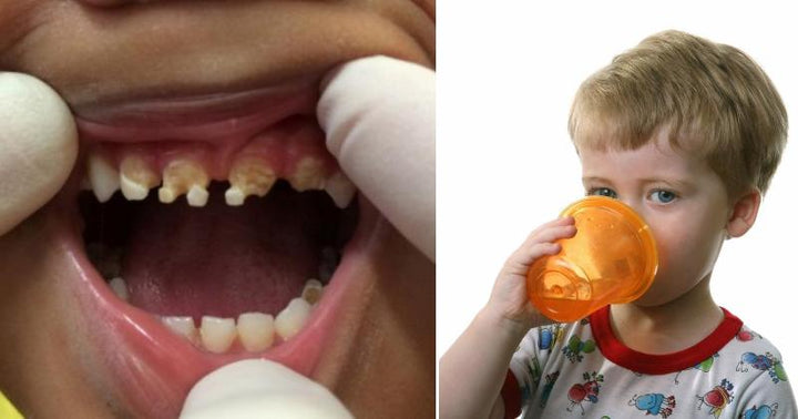 child tooth decay FI