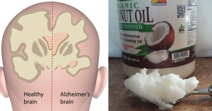 coconut oil alzheimers study FI