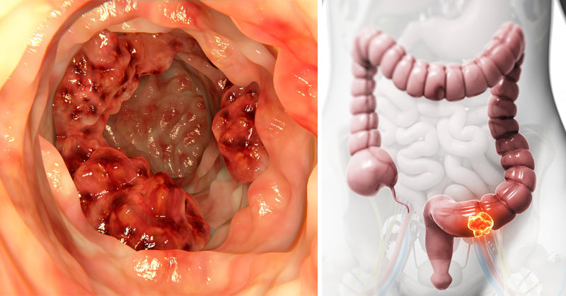 coconut oil colon cancer FI