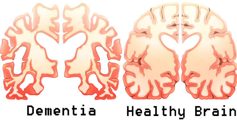 coffee dementia FI