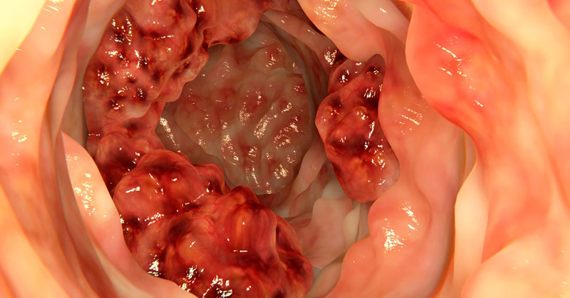 colon cancer warning signs FI