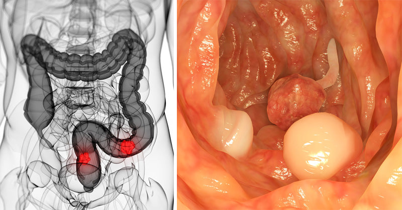 colon cancer risk FI