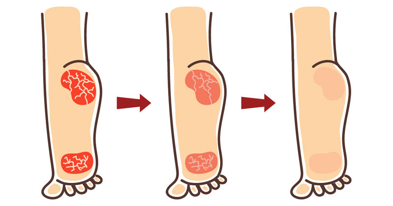 heal cracked heels FI