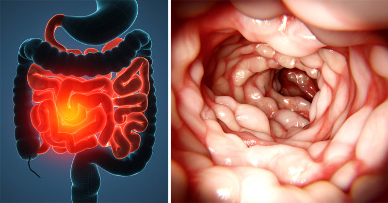 crohn disease symptoms FI