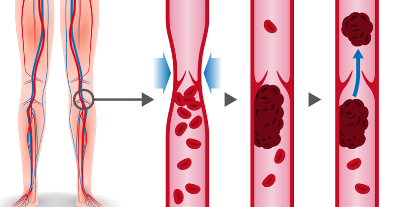 deep vein thrombosis FI