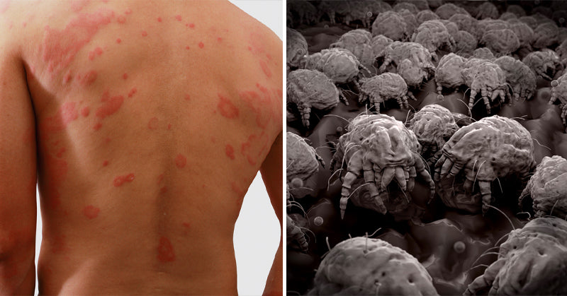 dust mite rash FI